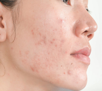 What Adult Acne Is Actually Telling You.